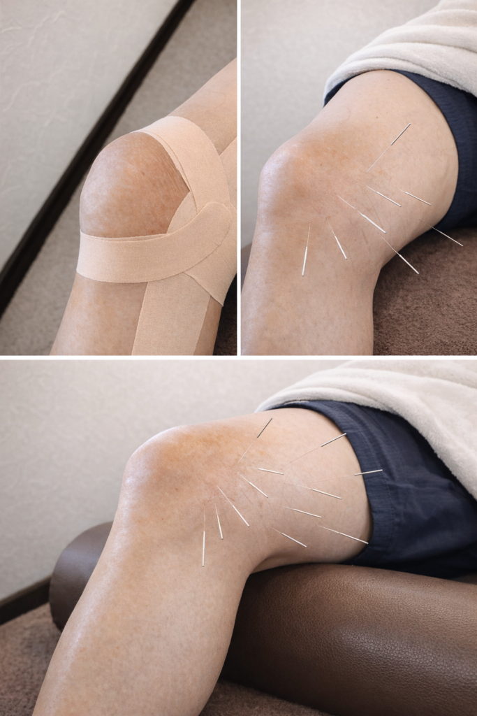 膝の鍼治療とは？｜宝塚市の鍼灸整骨院が解説