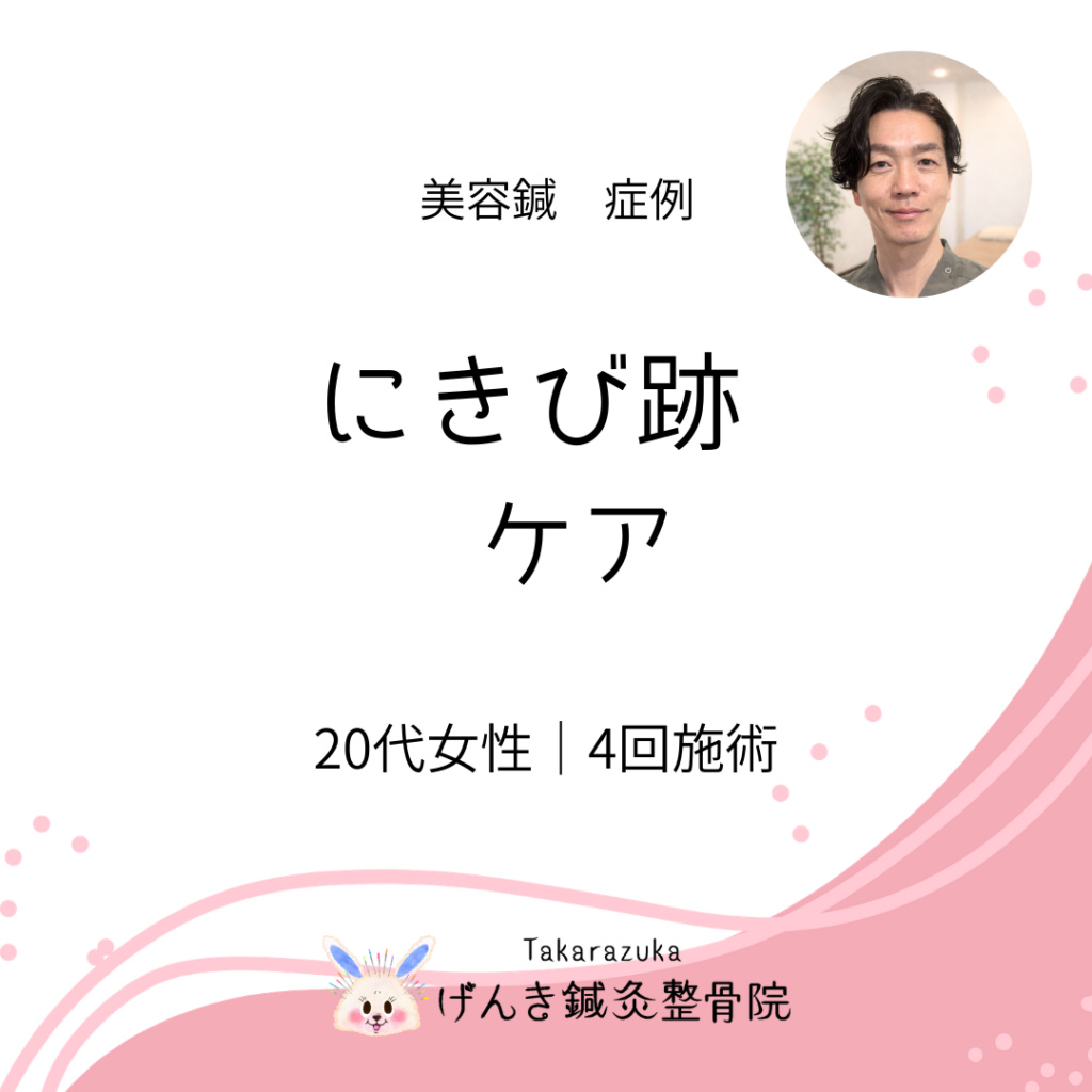 【症例】宝塚市 20代女性｜ニキビ跡が気になるお悩み｜美容鍼4回経過（美顔プレミアム100本）